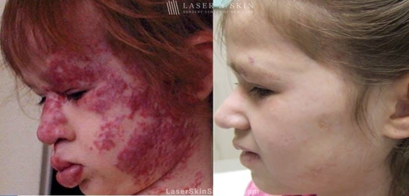 before and after image of a Laser treatment to remove a facial birthmark on a little girl