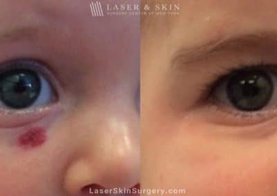 Laser Treatment for Infantile Facial Hemangioma