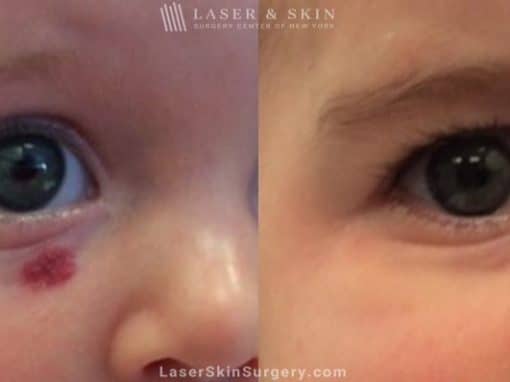 Laser Treatment for Infantile Facial Hemangioma