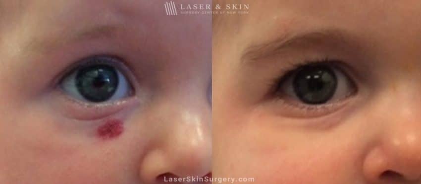 before and after image of a laser treatment for infantile facial hemangioma