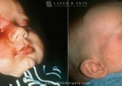 Laser Treatment for Birthmark Removal