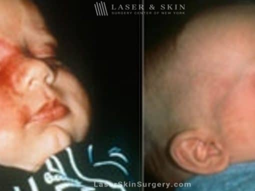 Laser Treatment for Birthmark Removal