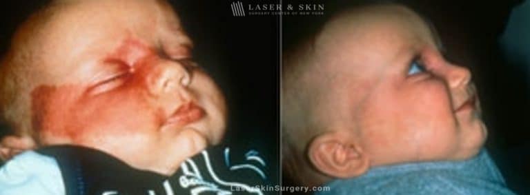 Laser Treatment for Birthmark Removal