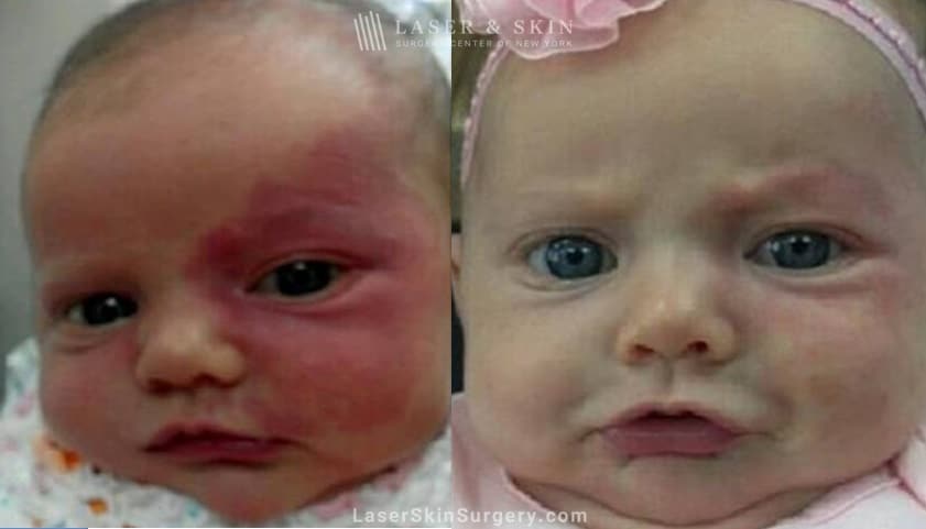 before and after image of a Laser Treatment for Birthmark Removal