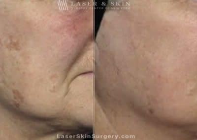 Laser Treatment for Brown Spots and Sun Damage on the Face