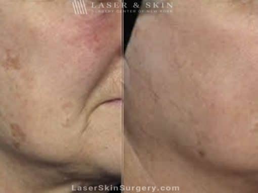 Laser Treatment for Brown Spots and Sun Damage on the Face