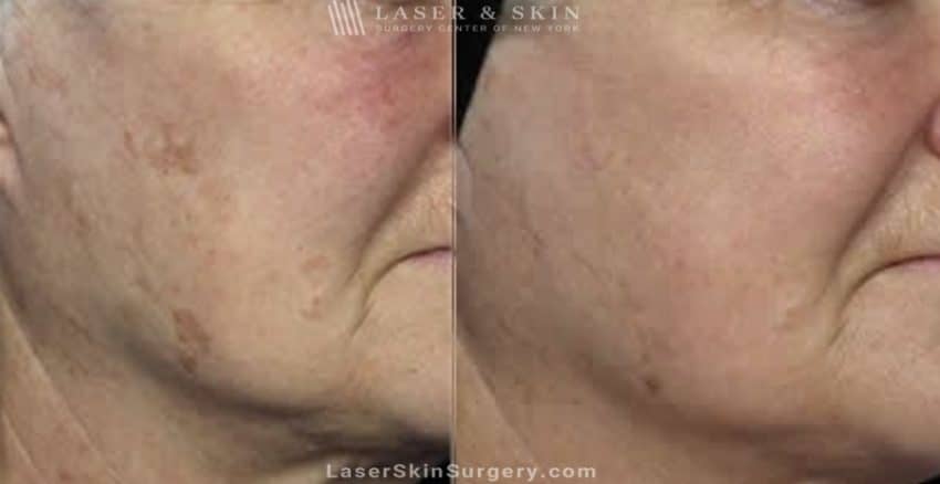 before and after image of a laser treatment for sun damage near the eyes