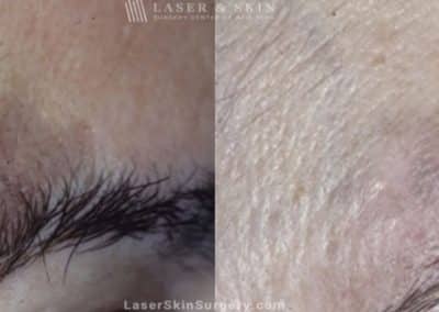 Laser Treatment for Brown Spots and Sun Damage Above the Eye