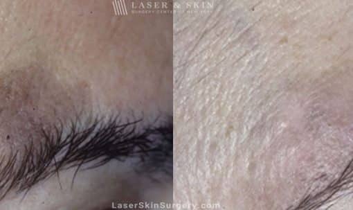 Laser Treatment for Brown Spots and Sun Damage Above the Eye