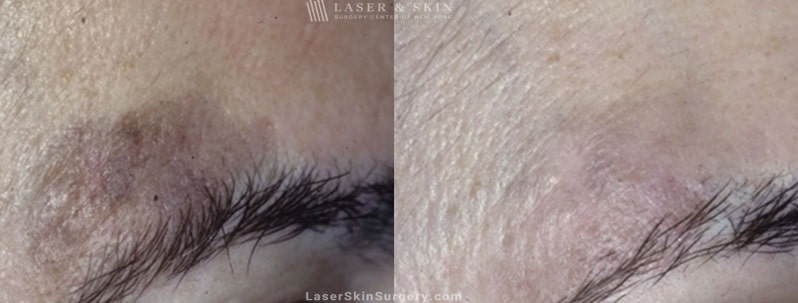 before and after image of a laser treatment to remove brown spots above the eye