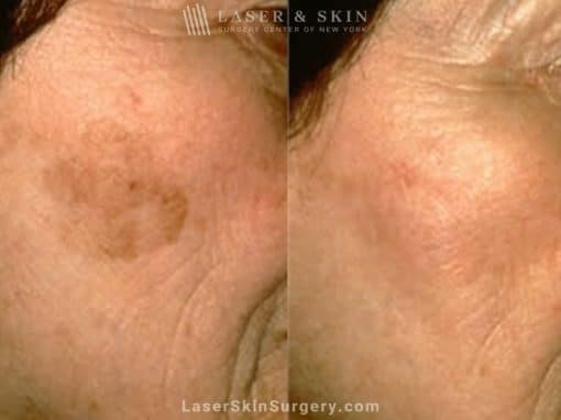 Laser Treatment to remove large brown spot on patient’s cheek