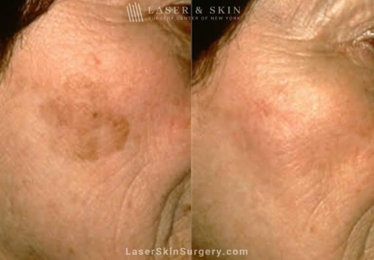 Laser Treatment to remove large brown spot on patient’s cheek