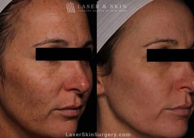 Laser Treatment for Brown Spots and Sun Damage on the Cheeks