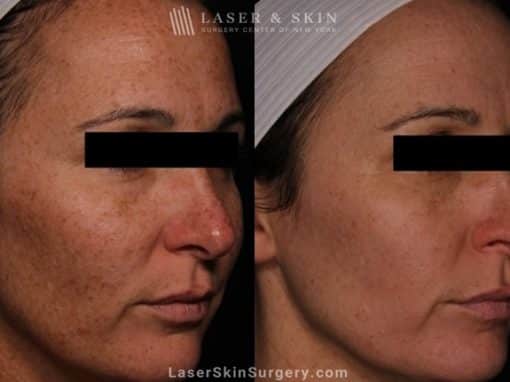 Laser Treatment for Brown Spots and Sun Damage on the Cheeks