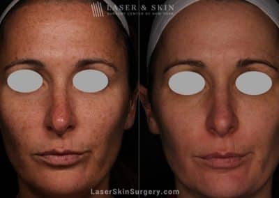 Laser Treatment for Brown Spots and Sun Damage on the Face