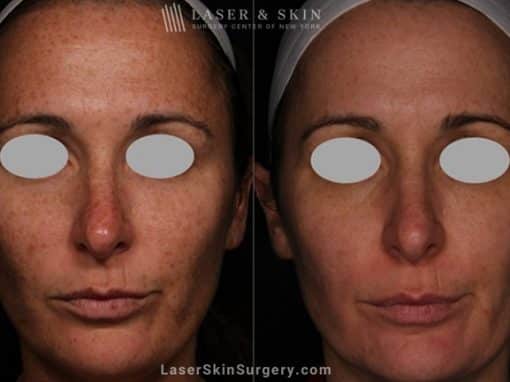 Laser Treatment for Brown Spots and Sun Damage on the Face