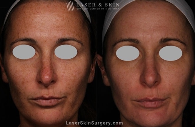 before and after image of a laser treatment for the removal of brown spots on a woman's face