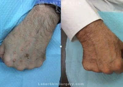 Laser Treatment for Sun Damage on the Hands