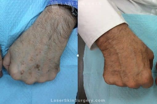 Laser Treatment for Sun Damage on the Hands