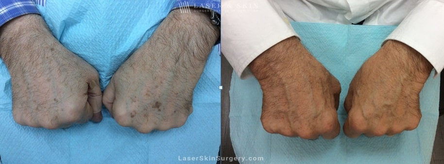 before and after image of a laser treatment for the removal of brown spots and or sun damage on a man's hands