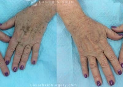 Laser to remove brown spots and treat other sun damage on patient’s hands