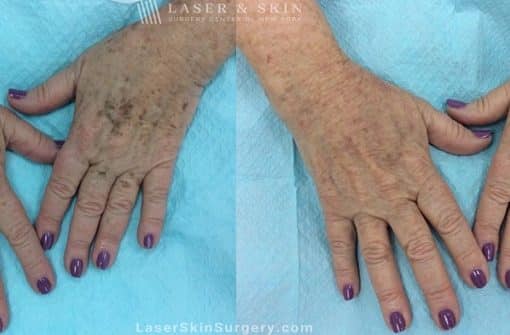 Laser to remove brown spots and treat other sun damage on patient’s hands