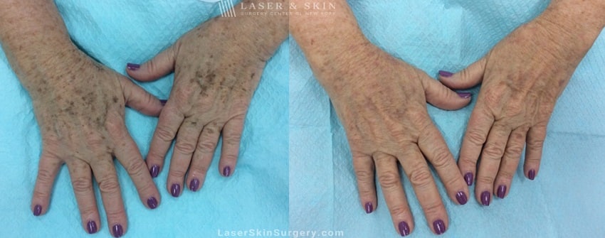 before and after image of a laser treatment for the removal of brown spots on a woman's hands