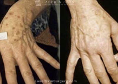 Laser Treatment for Sun Damage on the Hands