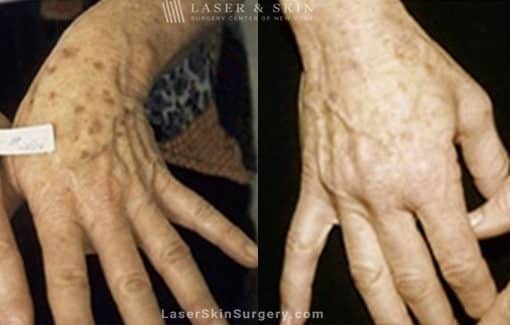 Laser Treatment for Sun Damage on the Hands