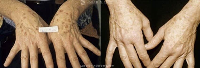 before and after image of a laser treatment for the removal of brown spots on a woman's hands