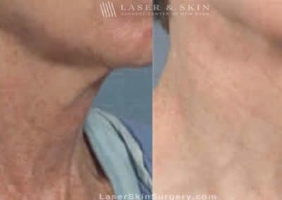 Laser Treatment for Brown Spots and Sun Damage on the Neck