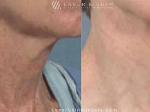 Laser Treatment for Brown Spots and Sun Damage on the Neck