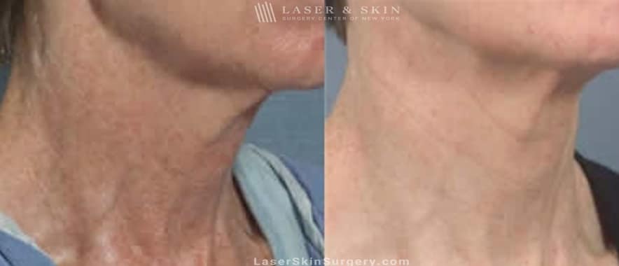 before and after image of a laser treatment for the removal of brown spots and sun damage on a woman's neck