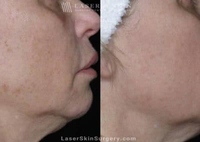 Laser Treatment for Brown Spots on the Cheeks