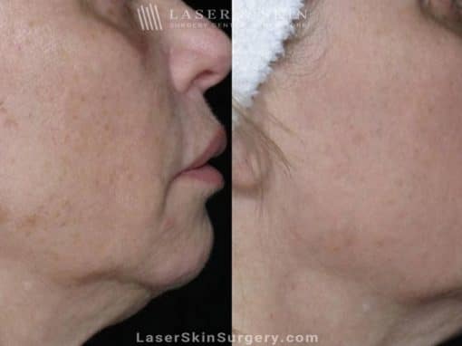 Laser Treatment for Brown Spots on the Cheeks