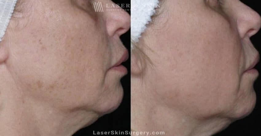 before and after image of a laser treatment for the removal of sun damage on a woman's cheeks