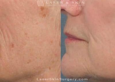 Laser Treatment for Brown Spots and Wrinkles
