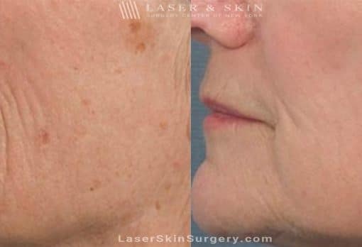 Laser Treatment for Brown Spots and Wrinkles