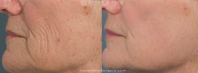 Laser Treatment for Brown Spots and Wrinkles