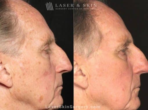 Laser Treatment for Actinic Keratosis on a Man’s Face