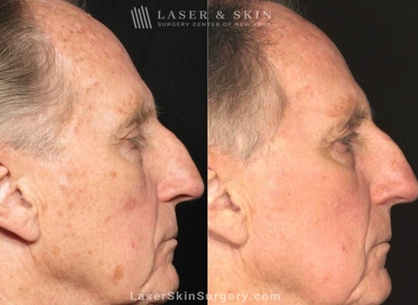 before and after image of a laser treatment for the removal of brown spots on a man's face