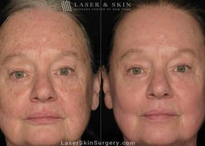 Laser Treatment for Actinic Keratosis on Female Patient