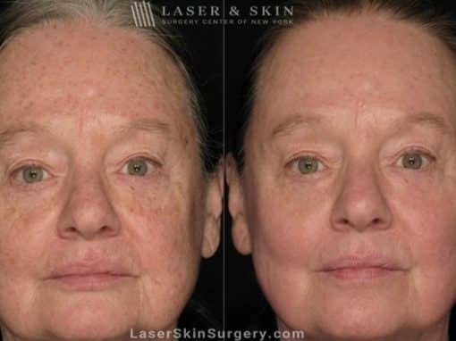 Laser Treatment for Actinic Keratosis on Female Patient