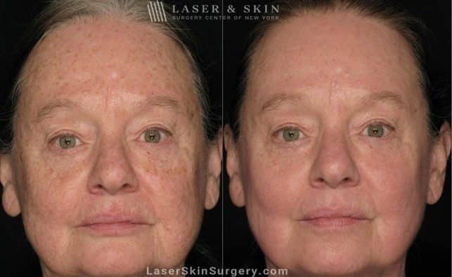 Laser Treatment for Actinic Keratosis on Female Patient