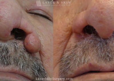 Laser Treatment for Rhinophyma on a Man’s Nose