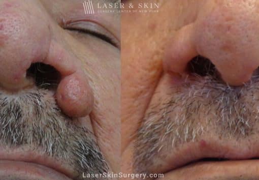 Laser Treatment for Rhinophyma on a Man’s Nose