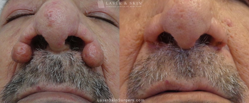 before and after image of a laser treatment for Rhinophyma on a man's nose