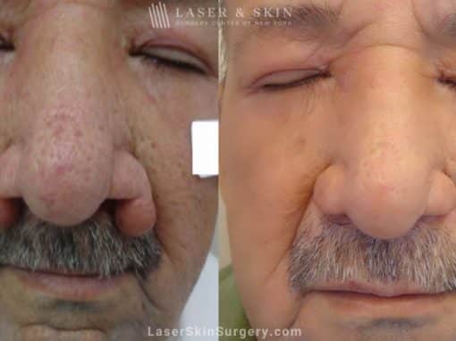 Laser Treatment for Rhinophyma on a Man’s Nose