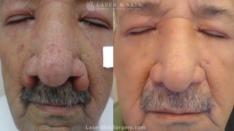 before and after image of a laser treatment for Rhinophyma on a mans nose