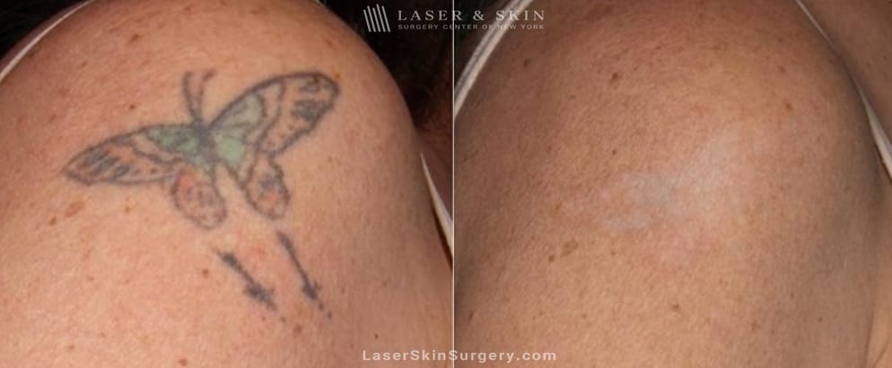 lsscny laser tattoo removal butterfly before and after new york ny